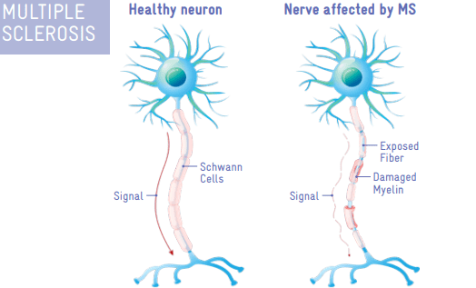 Multiple Sclerosis